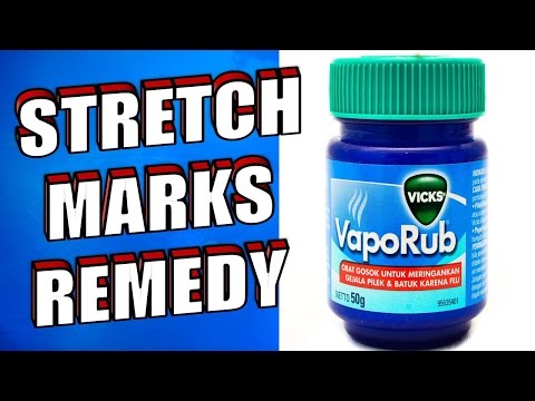 How to Remove Stretch Marks Using Vicks Vaporub