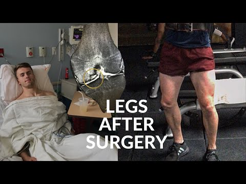 Never Giving Up On Leg Day | Lifting After Surgery | Fitness Motivation